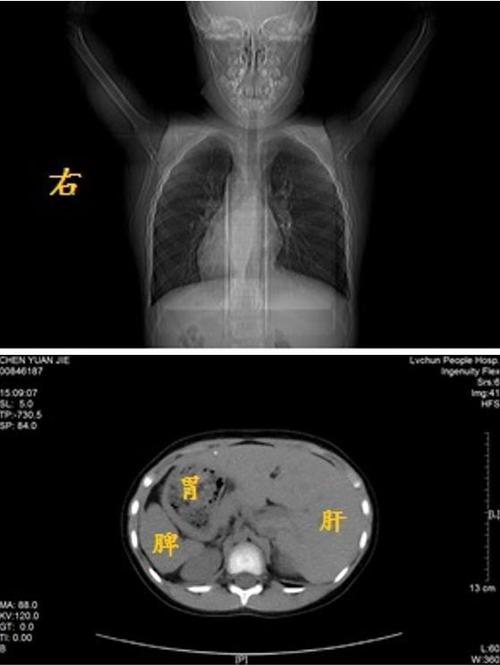 五一放假去哪里玩看肺炎被确诊镜面人会传染吗看肺炎被确诊镜面人